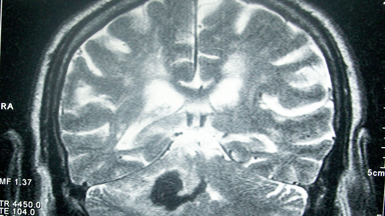 image stroke mri